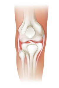 Image of the front of the knee featuring the meniscus