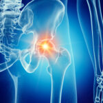 Hip Pain causing problems with snapping hip syndrome