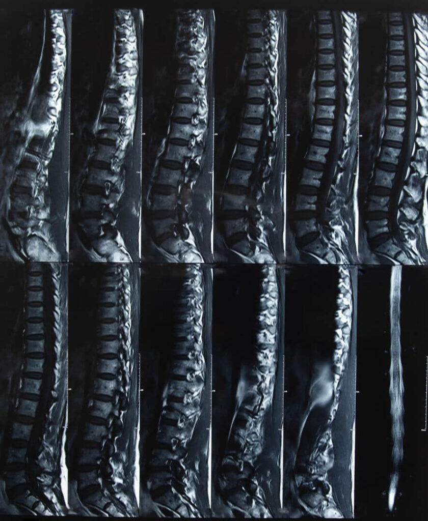 Images of the spine helping to understand back pain